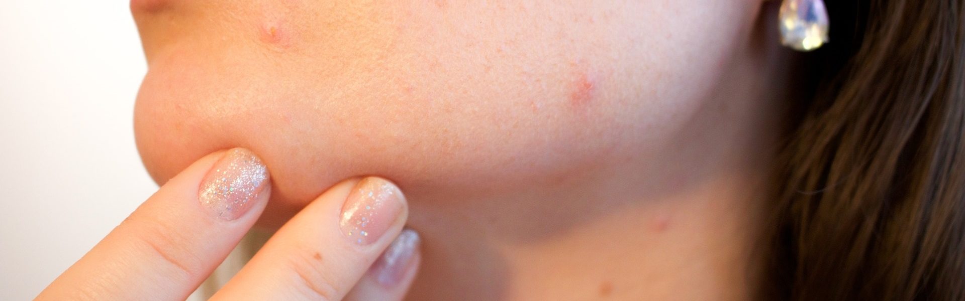 Are Chemical Peels Good for Acne? banner