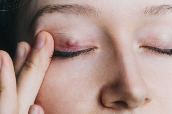 There’s a bump on my eyelid, is it cancer? featured image