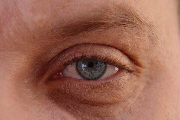 I noticed my eyelid drooping, how can I tell if it’s ptosis or something else? featured image