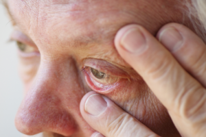 Understanding eyelid conditions: Causes, symptoms, and treatment options featured image