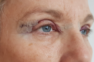 Blepharoplasty recovery guide: Tips for a smooth healing process featured image
