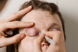 Brighter Eyes, Brighter You: The Art of Blepharoplasty featured image