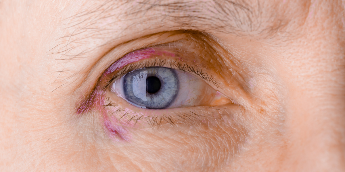 Navigating eyelid and orbital trauma: Understanding treatment priorities and options banner