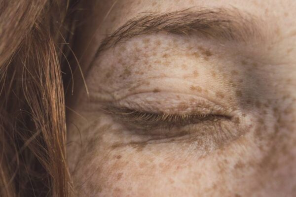 Skin Cancer Awareness Month: Eyelid Malignancy featured image