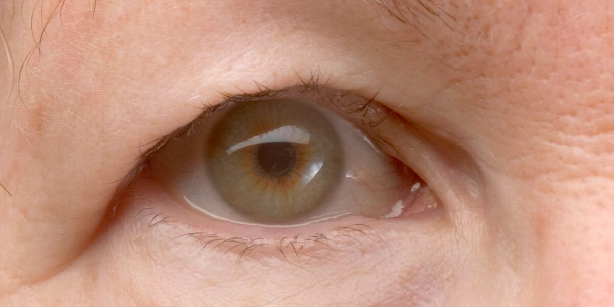 Eyelid Surgery in Fairfax banner