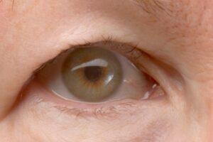 Eyelid Surgery in Fairfax featured image